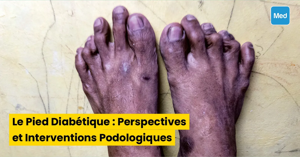 Le Pied Diabétique : Perspectives et Interventions Podologiques